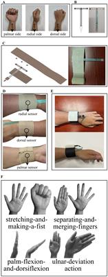 Wearable rehabilitation wristband for distal radius fractures